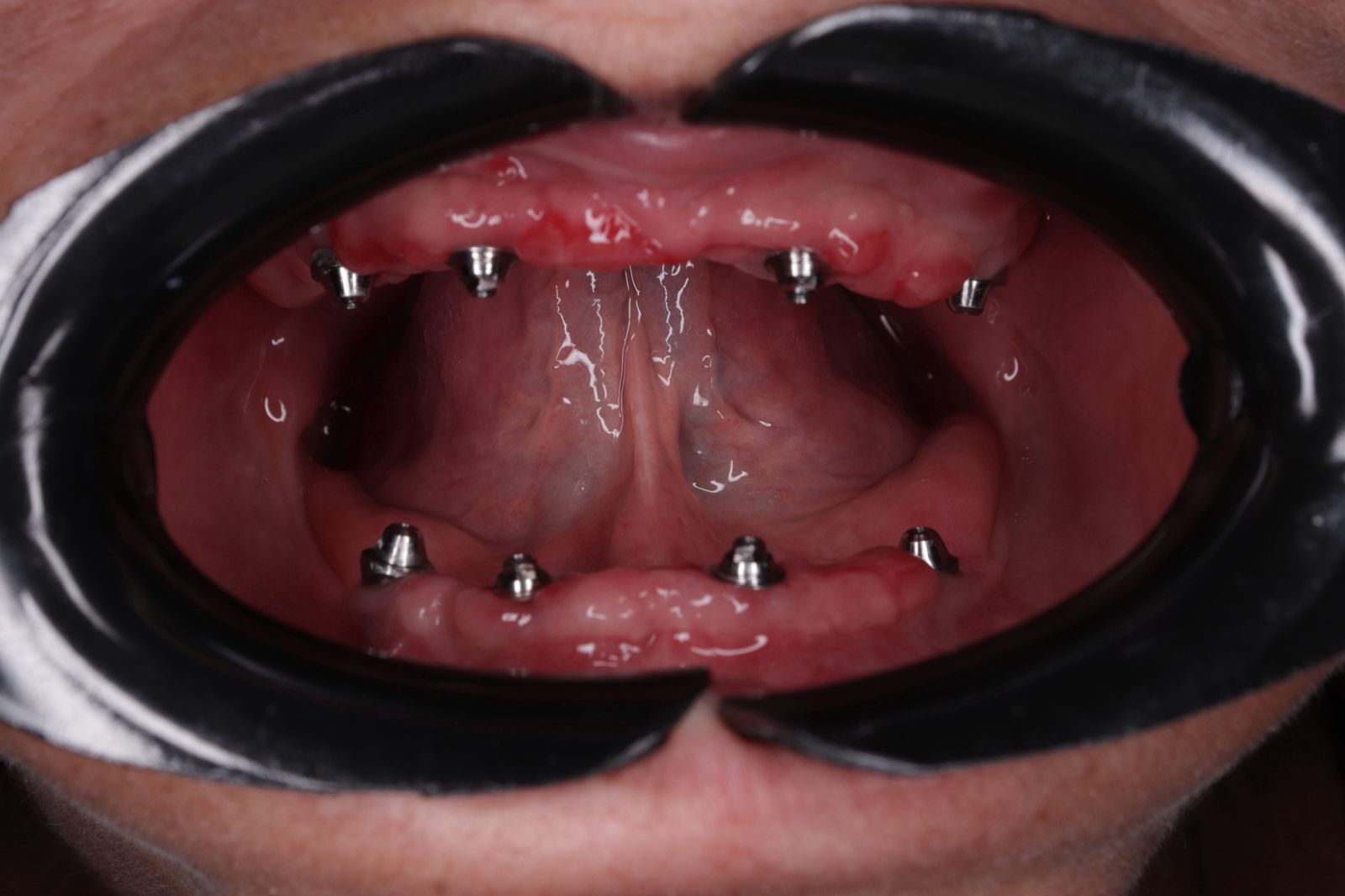 Caso clínico: Rehabilitación de protesis hibrida